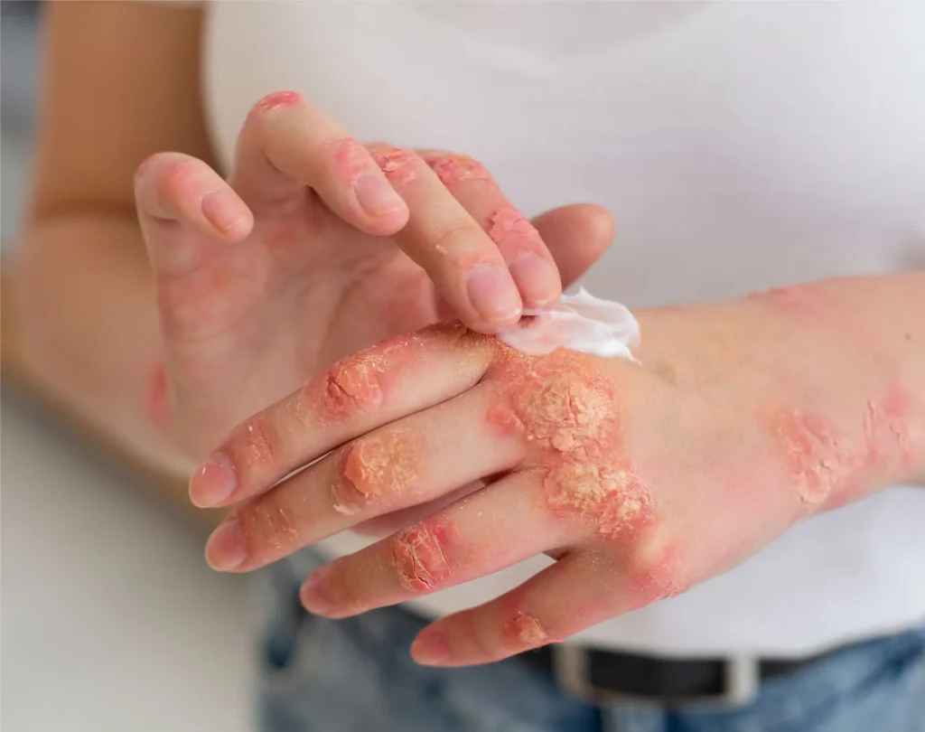 Fattah Primary Care-Skin Rash-Images-05