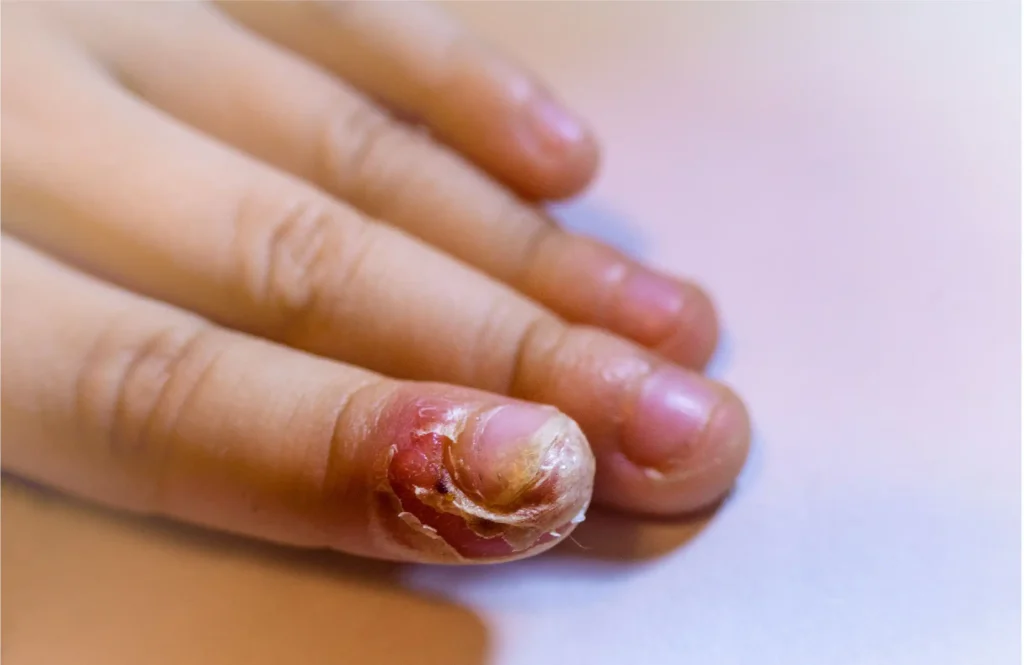 WeCareUrgentCare-Infected Tongnail-03