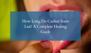 How Long Do Canker Sores Last A Complete Healing Guide