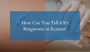 ringworm-vs-eczema