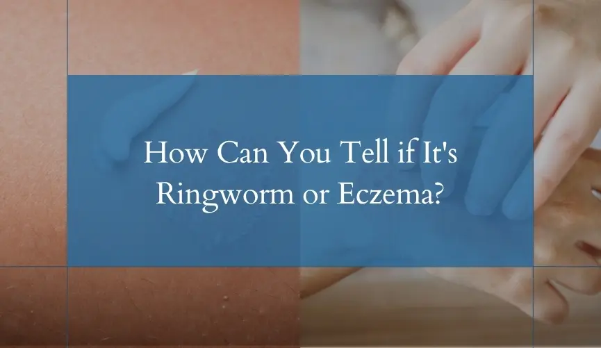 ringworm-vs-eczema